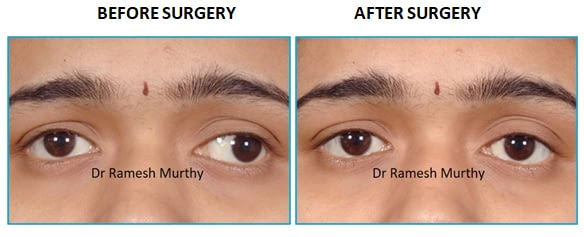 Squint Surgery Axis Eye Clinic 