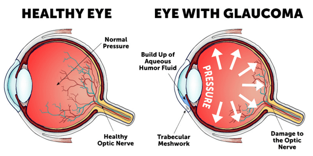 how-can-one-differentiate-between-cataract-and-glaucoma-axis-eye-clinic