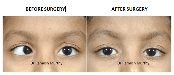 Squint Surgery - Axis Eye Clinic