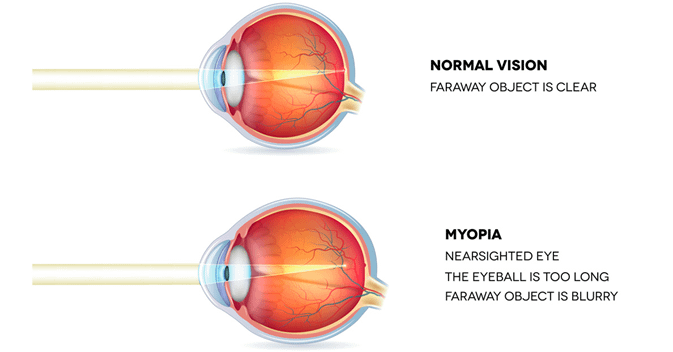 Atropine Eye Drops for Myopia in Children - Dr. Ramesh Murthy