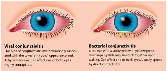 Pink Eye Acute Conjunctivitis Dr Ramesh Murthy