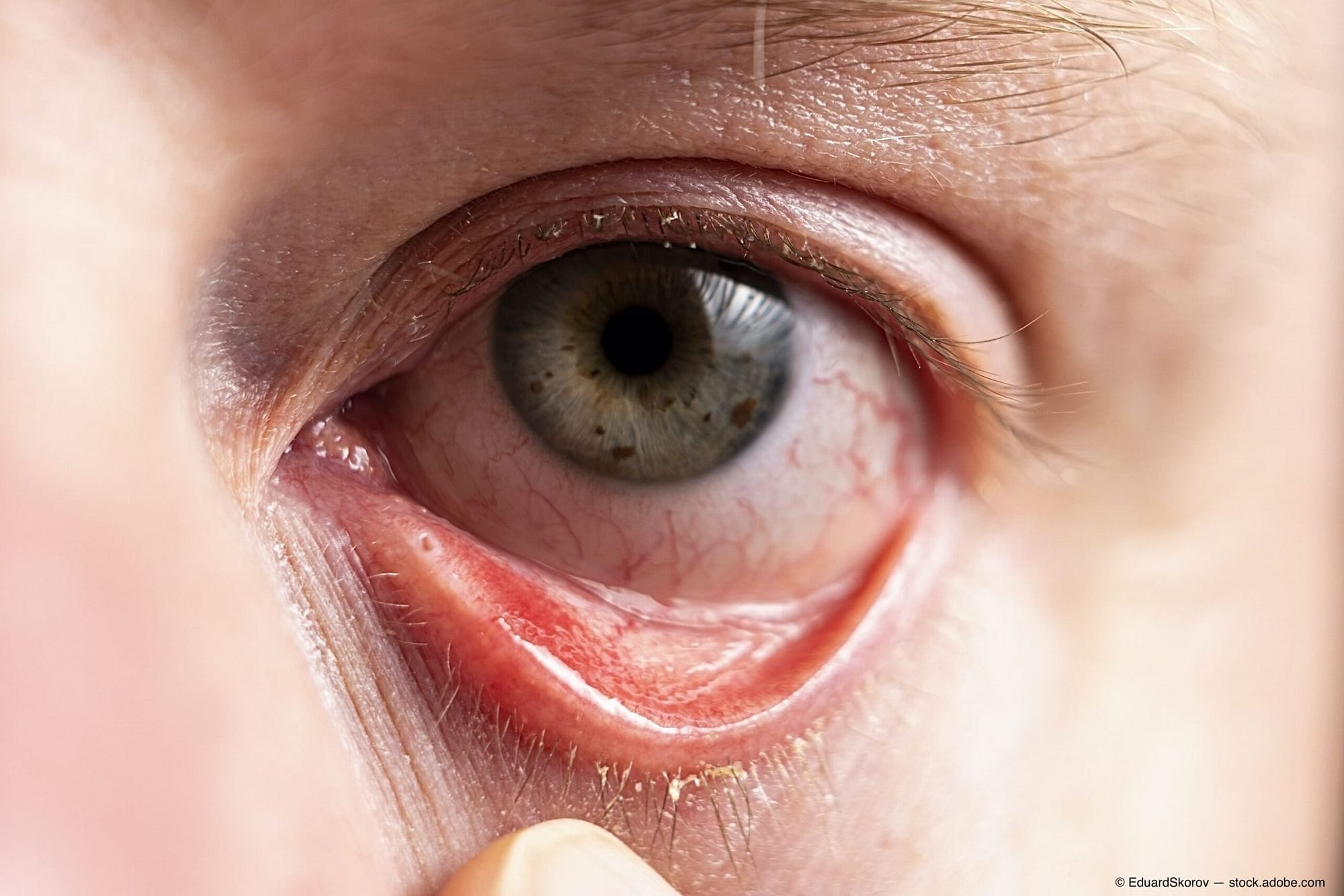 Allergic Conjunctivitis Axis Eye Clinic 