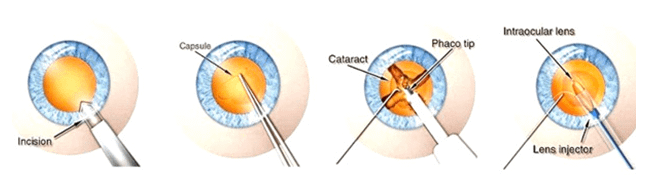 Modern Technique of Cataract Surgery in Pune India - Axis Eye Clinic