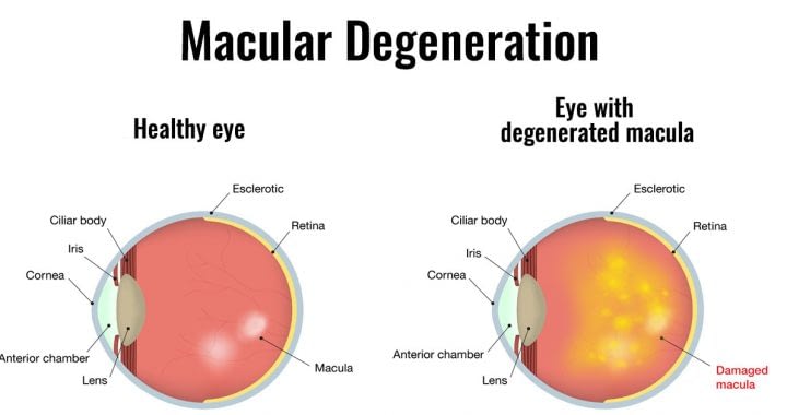 Age Related Macular Degeneration Dr. Ramesh Murthy