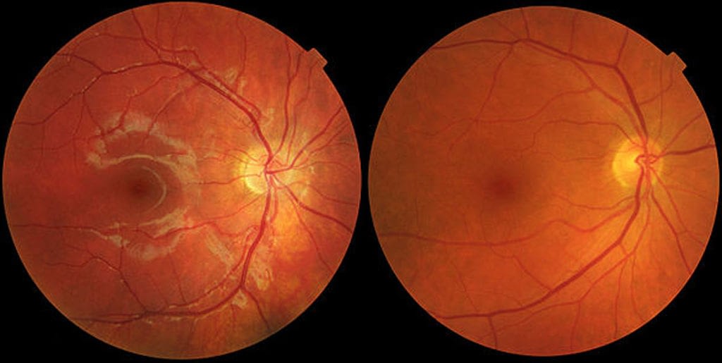 is-age-related-macular-degeneration-treatable-axis-eye-clinic