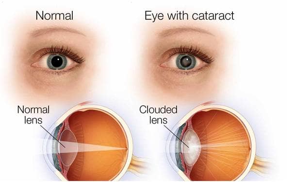 WHICH IS THE BEST INTRAOCULAR LENS (IOL) FOR CATARACT SURGERY? - Axis ...